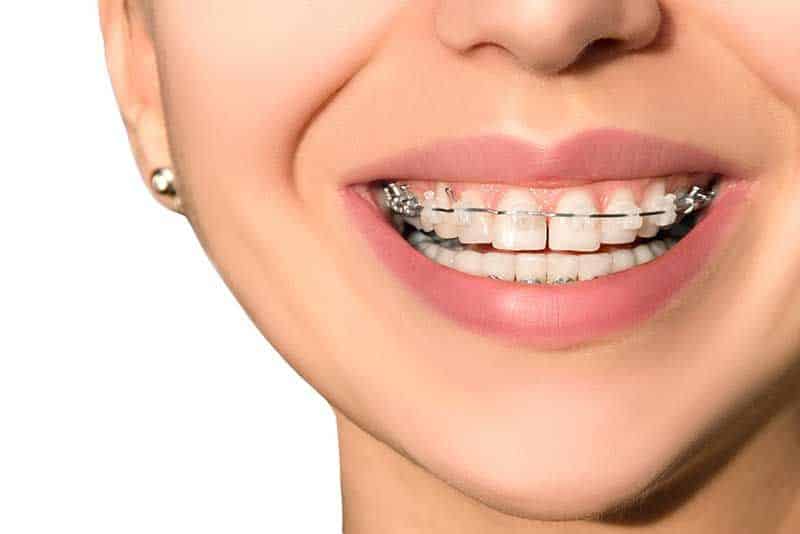 ortodoncia damon indicaciones 4 Álvarez Luckow
