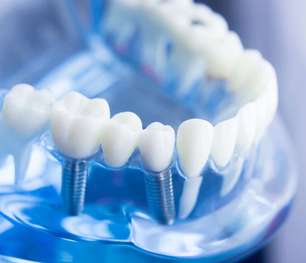 implantes dentales preguntas consejos Álvarez Luckow