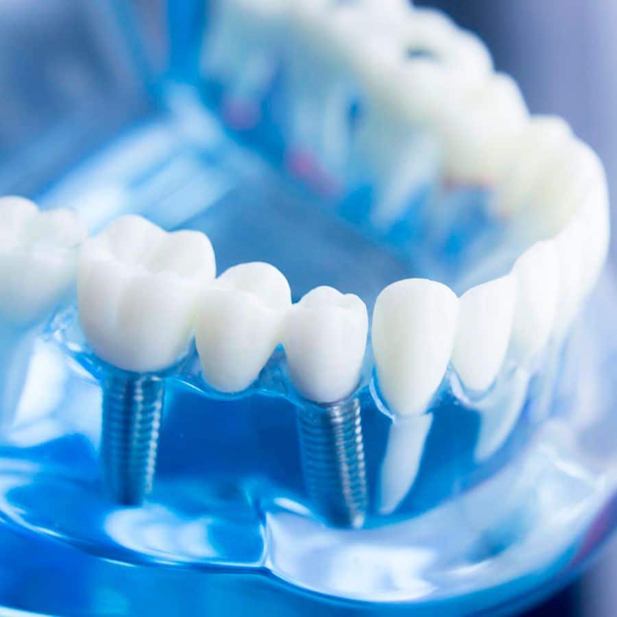 implantes dentales preguntas frecuentes Álvarez Luckow