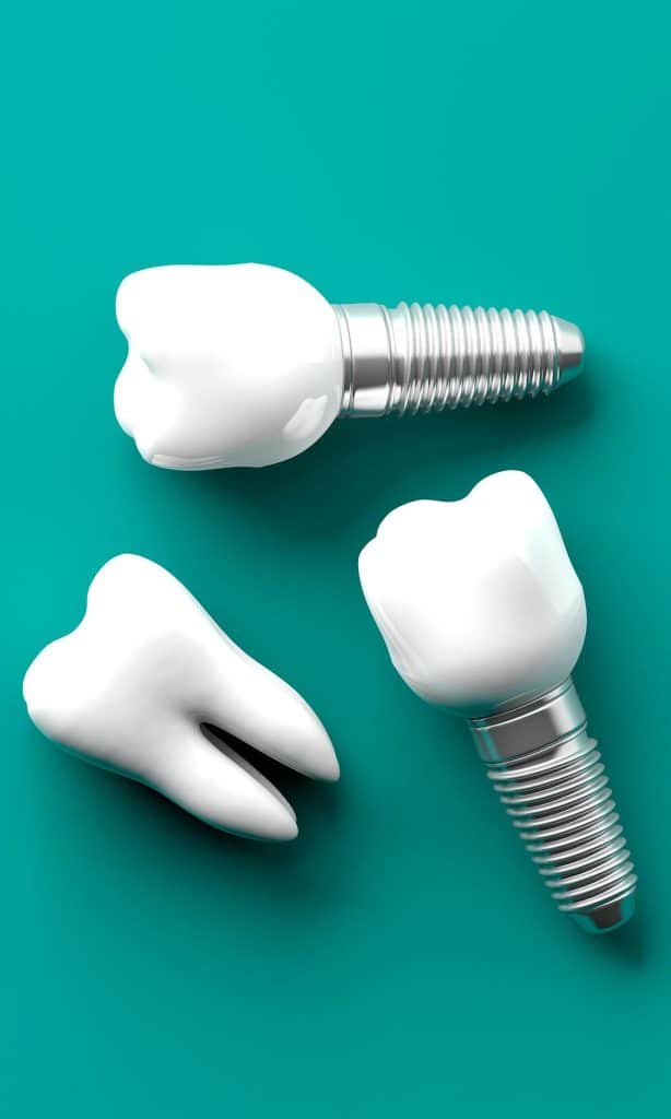 tratamientos implantes dentales majadahonda clinica alvarez luckow Álvarez Luckow
