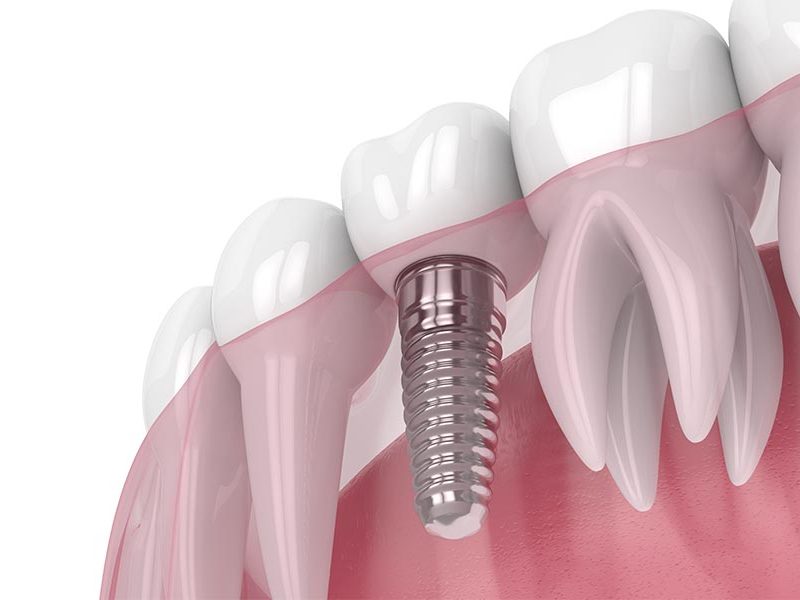¿Un implante dental duele?