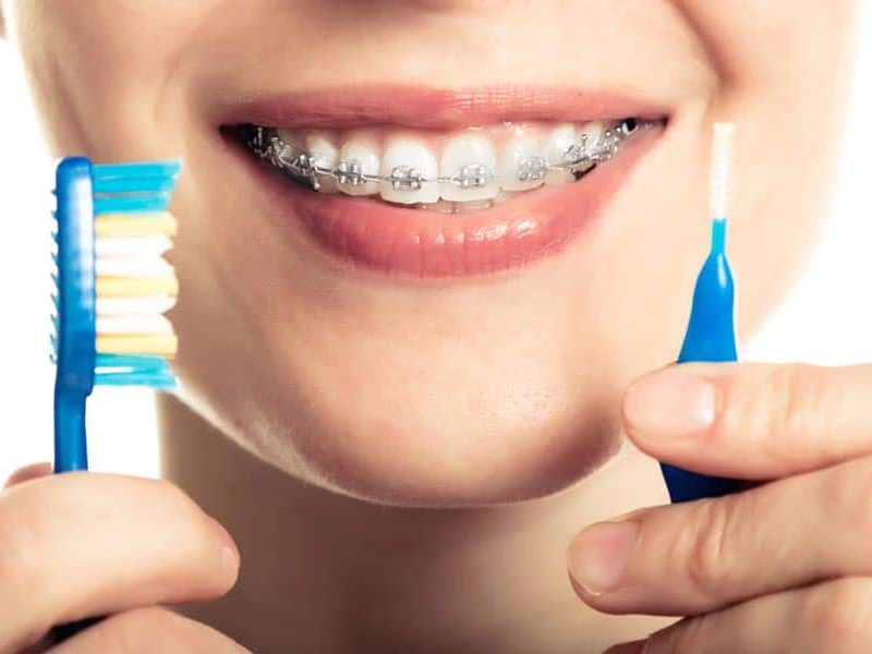 ¿Cómo cepillarse los dientes con brackets?