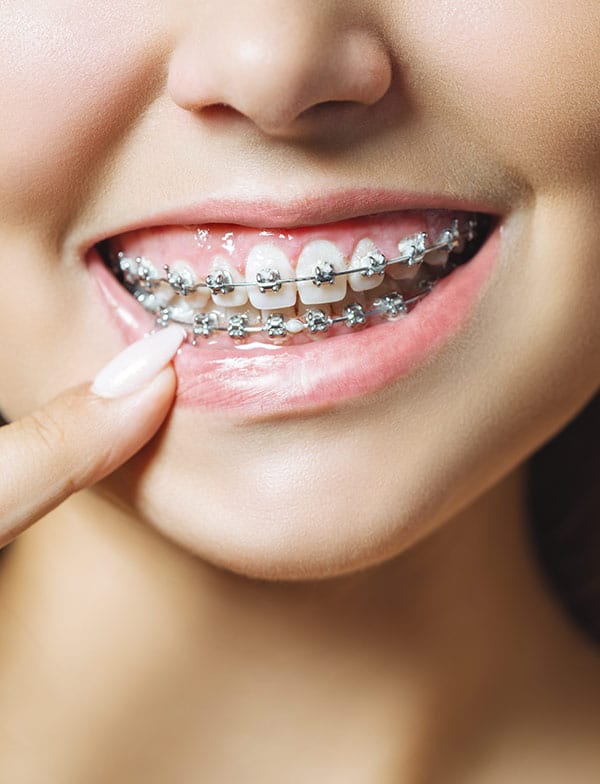 Beneficios Ortodoncia