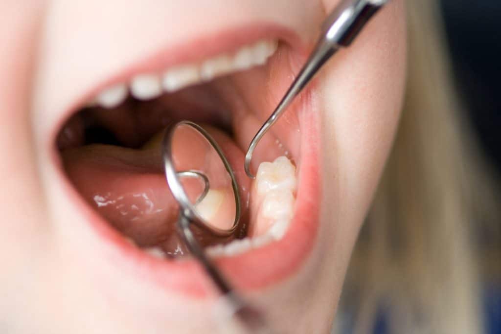 Empastes para caries infantil