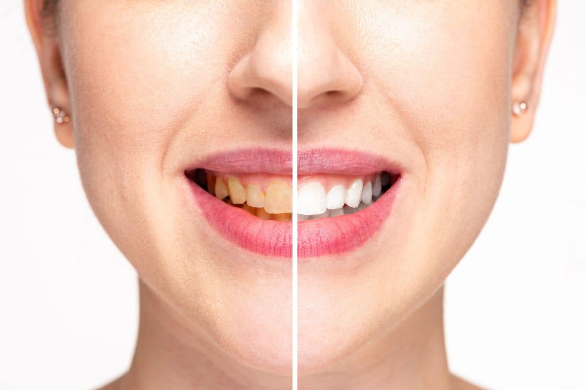 Desgaste del esmalte dental: causas y tratamientos