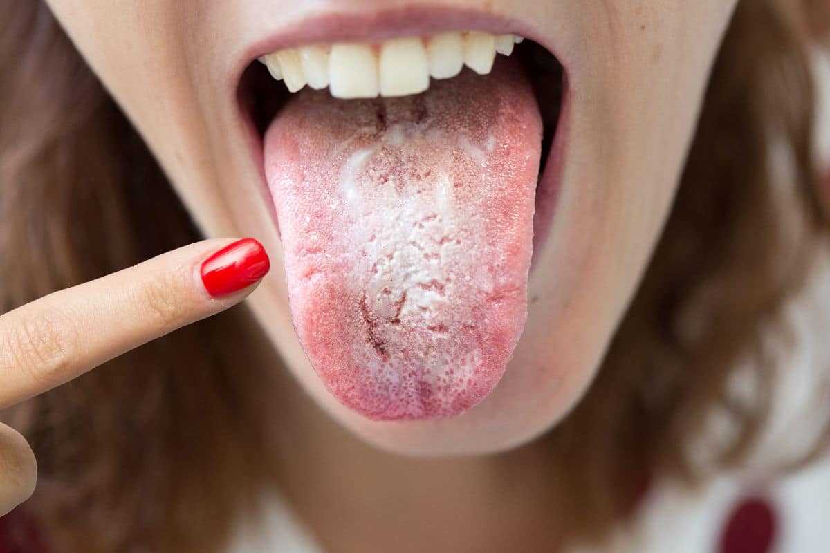 ¿Por qué se pone la lengua blanca?
