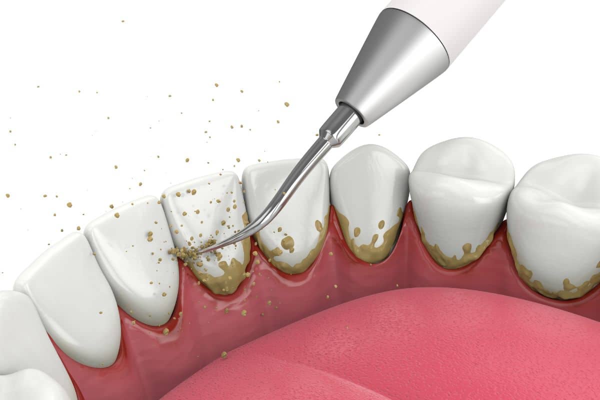 ¿Cómo evitar el sarro en los dientes?