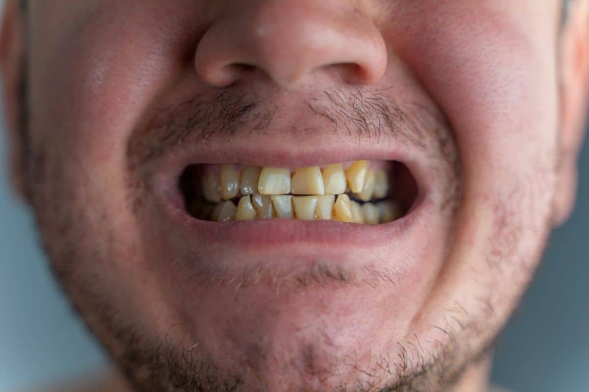Manchas marrones en los dientes