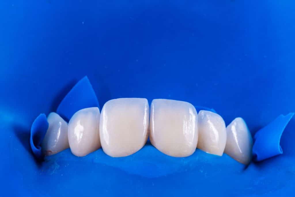 Carillas dentales fondo azul