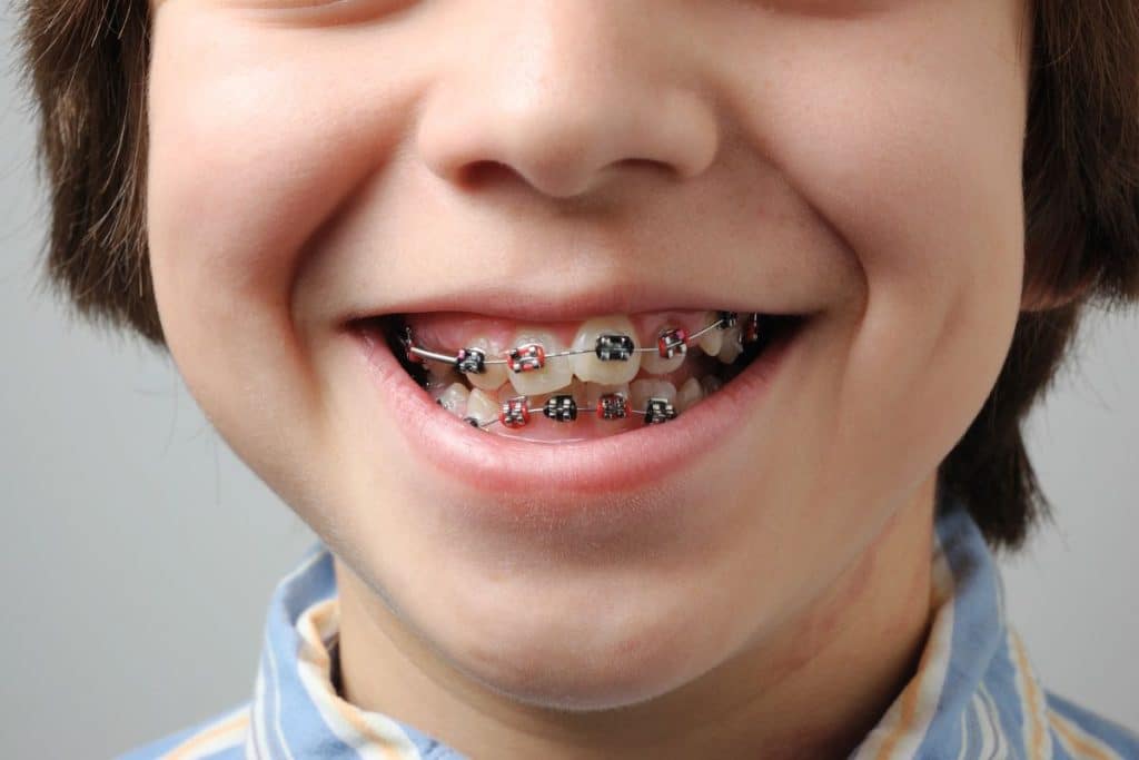 Ortodoncia fija (brackets)