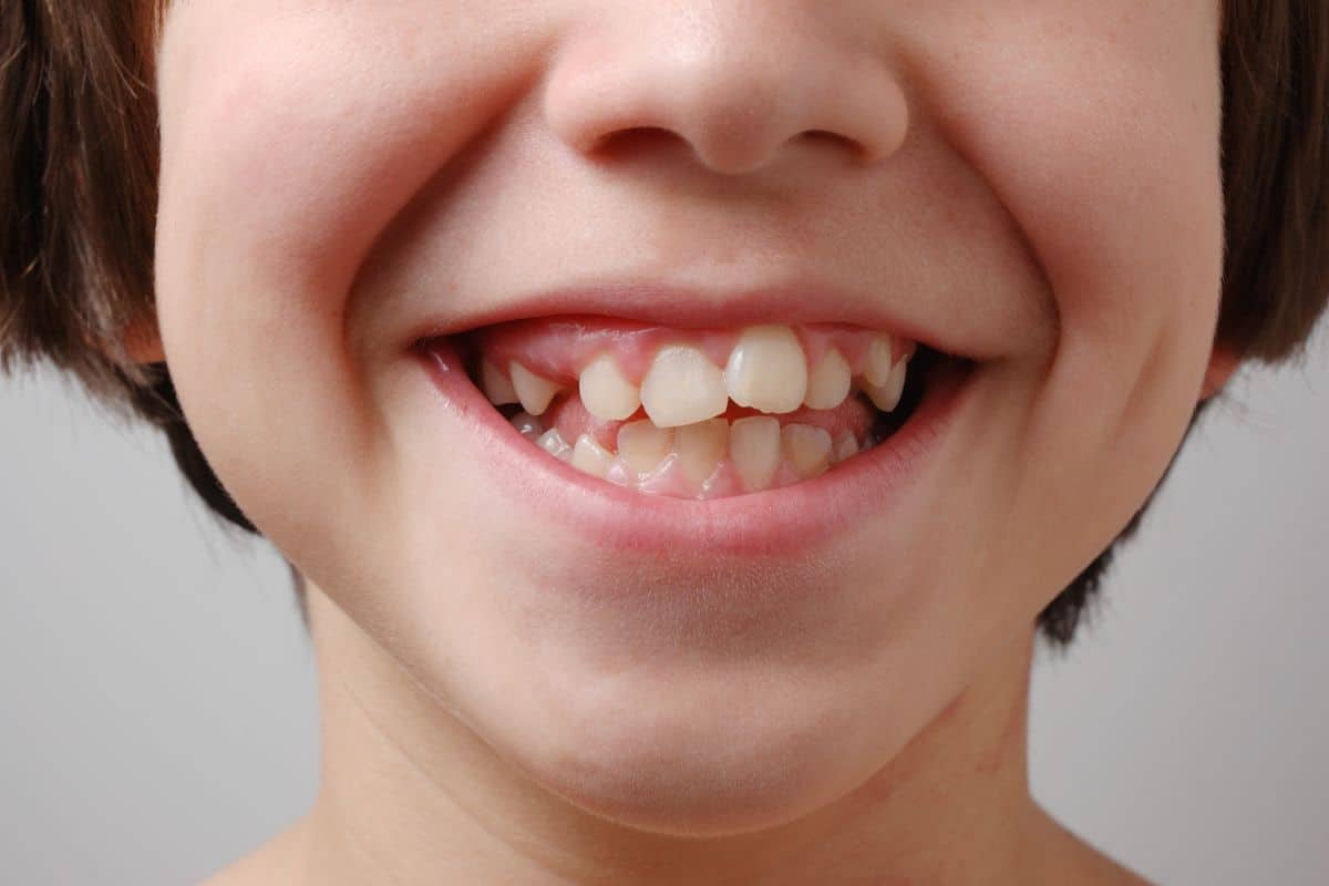 ¿Qué hago si mi hijo tiene los dientes torcidos?