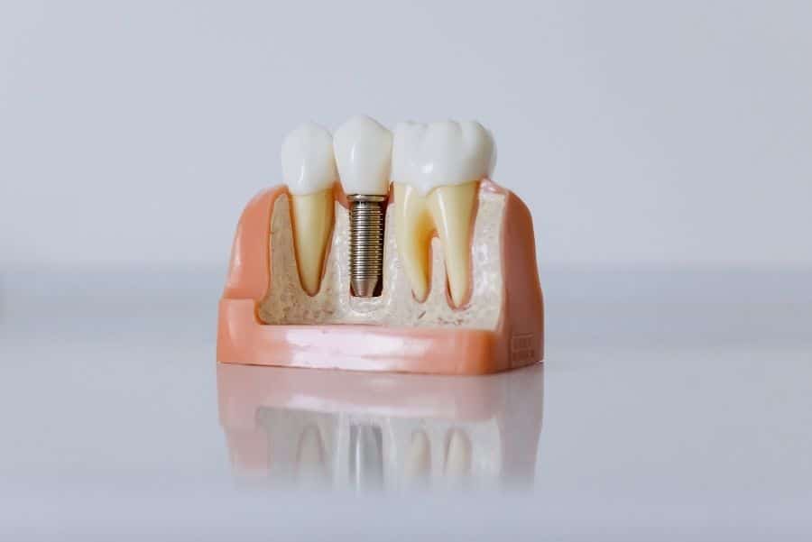 Qué debes saber antes de colocarte un implante dental