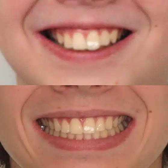 slide blocks antes y despues Álvarez Luckow