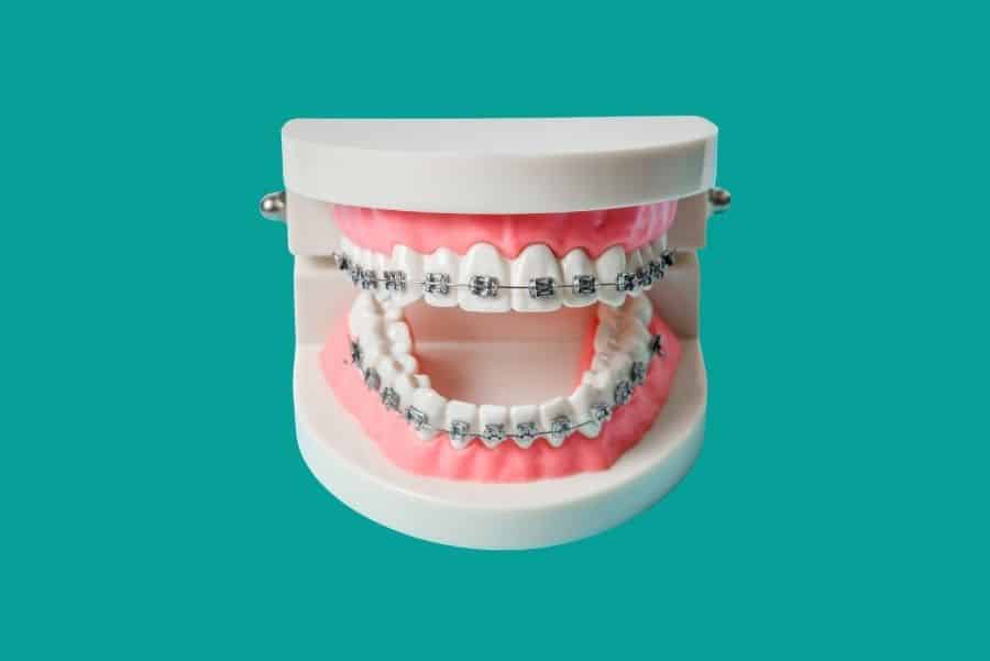 Brackets metálicos ventajas