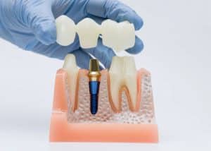 Partes de un puente dental