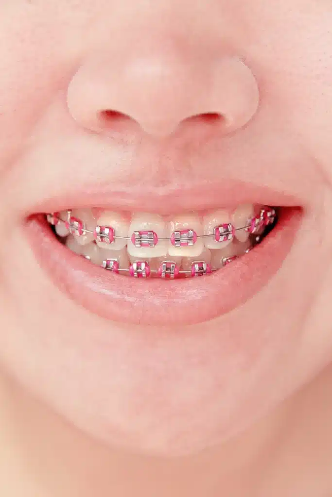 Recomendación Brackets Metálicos